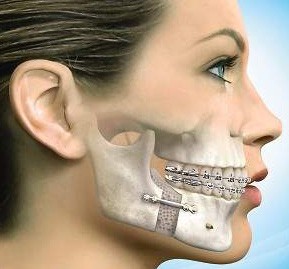 Cirurgia Ortognática